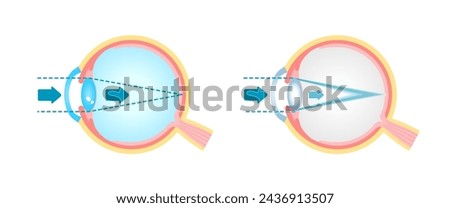 Causes and mechanism of cataract vector illustration