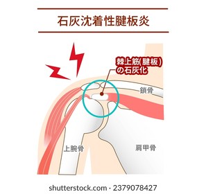 Causes and Mechanisms of Calcific Rotator Cuff Inflammation :Translate. supraspinatus muscle ,supraspinatus calcification ,Calcific Tendinopathy of the Shoulder