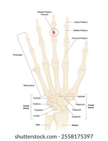 Causes of Middle Phalanx Fracture