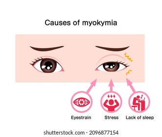 Causes Of Myokymia (eyelid Twitch Or Tic) Vector Illustration