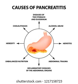 Causes of pancreatitis. The structure of the stomach and pancreas. Infographics. Vector illustration on isolated background