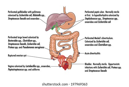 Causes of peritonitis -- labelled