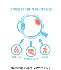 Causas de la hemorragia retiniana. Ilustración vectorial.