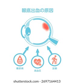 Causas de la hemorragia retiniana. Ilustración vectorial. Traducción: Diabetes, Hipertensión, Envejecimiento.