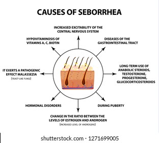 Causes of seborrhea. Seborrhea skin and hair. Dandruff, seborrheic dermatitis. Baldness, hair growth, baldness. Anatomical structure. Infographics. Vector illustration on isolated background.