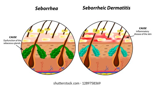 Causes Seborrhea skin and hair. Dandruff seborrheic dermatitis. Eczema. Dysfunction of the sebaceous glands. Inflammatory skin disease. Anatomical structure. Infographics. Vector illustration