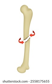 Causes of the Spiral Fracture