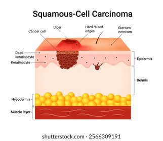 Causes of Squamous Cell Carcinoma