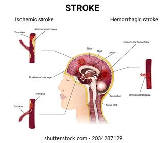 Causes Of Stroke And The Development Of The Disease, The Brain In A Section, Arteries With A Thrombus And Atherosclerotic Plaque, Intracerebral Bleeding, Medical Illustration Of Ischemic And Hemorrhag