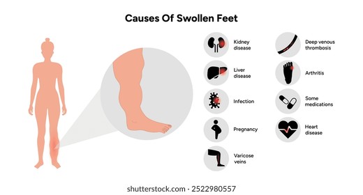 Causas do inchaço dos pés. Diagrama ortopédico e infográfico