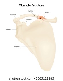 Causes and Symptoms of Clavicle Fracture