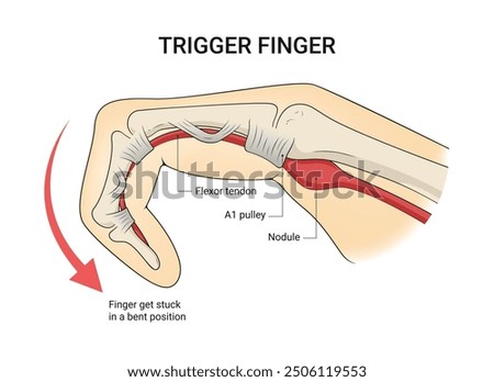 Causes and Symptoms of Trigger Finger
