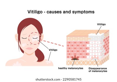 Causes and symptoms of Vitiligo vector illustration