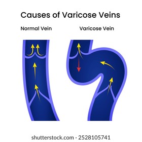 Causas das veias varicosas