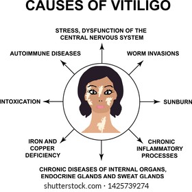 Causes of Vitiligo. World Vitiligo Day. Infographics. Vector illustration on isolated background.