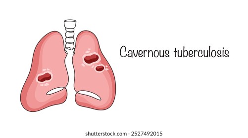 Cavernous tuberculosis. A form of pulmonary tuberculosis in which cavities are found. Drawn lungs with isolated cavities. Vector illustration.