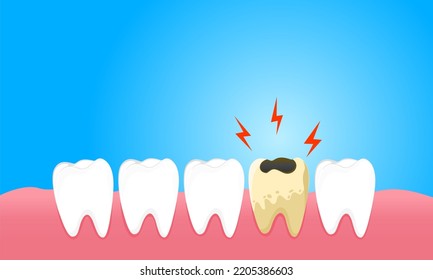 Cavities cause gum pain and tooth sensitivity.