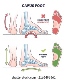 Cavus Foot With Abnormal High Arch Condition To Feet Bones Outline Diagram. Labeled Educational Medical Deformation Compared With Healthy Model Vector Illustration. Orthopedic Skeletal Pathology.