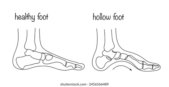 Cavus foot syndrome is characterized by an excessively high longitudinal arch of the foot. Healthy leg and leg with deformity. Medical illustration. Isolated vector on white background.