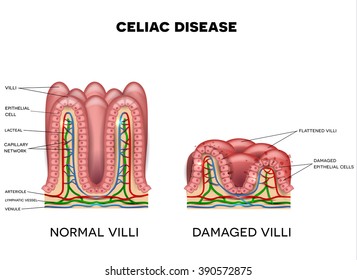 Celiac disease affected small intestine lining on a white background. Healthy and damaged villi.