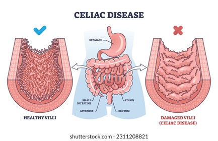 Celiac disease as chronic digestive and immune disorder outline diagram. Labeled educational scheme with healthy and damaged villi comparison vector illustration. Small intestine illness anatomy.