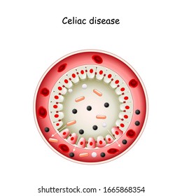 Celiac disease. Cross section of Small intestine lining damage. good and damaged villi. leaky gut. Coeliac (sprue) disease: an autoimmune disorder against gluten (gliadin). 