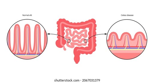 Celiac Disease. Damaged And Normal Intestinal Villi In Surface Area Of Intestinal Walls. Small Intestine Cross Section, Microvilli And Epithelial Cells. Digestive System Medical Vector Illustration