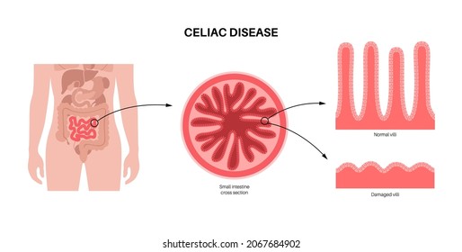 Celiac disease. Damaged and normal Intestinal villi in surface area of intestinal walls. Small intestine cross section, microvilli and epithelial cells. Digestive system medical vector illustration