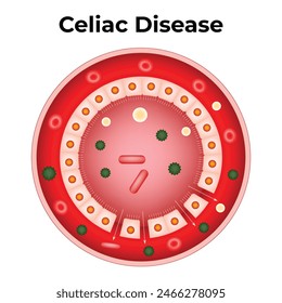 Celiac Disease Science Design Vector Illustration Diagram