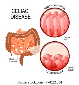 Celiac disease. small intestinal with normal villi, and villous atrophy. Diagram showing changes in intestinal. coeliac disease manifested by blunting of villi.