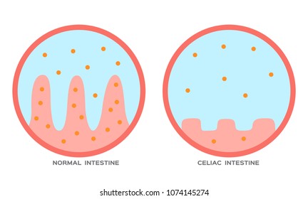 Celiac disease Small intestine lining damage. good and damaged villi . leaky gut progression