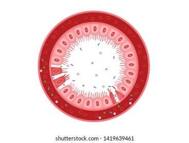 Celiac Disease Small Intestine Lining Damage. Good And Damaged Villi . Leaky Gut Progression