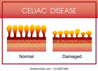 Celiac Disease, Vector Design