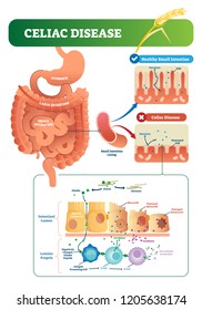 Celiac disease vector illustration. Labeled diagram with its structure. Autoimmune illness in stomach and intestine. Scheme with nutrients, healthy and destroyed villi.