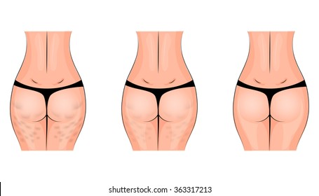 cellulite, cellulitis. buttocks