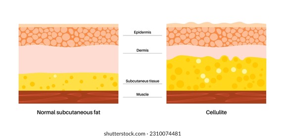 Concepto celulítico, exceso de grasa en el cuerpo humano. Sobrepeso y aumento del diagrama de grasa subcutánea. Personas obesas, programa de dieta. Estructura de las capas de la piel de la epidermis, dermis e hipodermis vectorial ilustración.