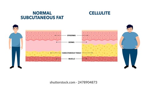 Cellulite concept, excess fat in human body. Overweight and increase subcutaneous fat diagram. Obese people, diet program. Skin layers structure epidermis, dermis and hypodermis vector illustration.