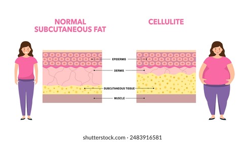 Cellulite concept, excess fat in human body. Overweight and increase subcutaneous fat diagram. Obese woman, diet program. Skin layers structure epidermis, dermis and hypodermis vector illustration.