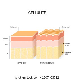 341 Cellulite Diagram Images, Stock Photos & Vectors | Shutterstock