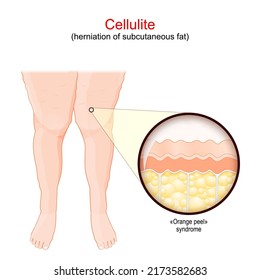 Cellulite. Females legs with Adiposis edematosa. Close-up of a human skin with Orange peel syndrome. herniation of subcutaneous fat. Vector illustration.