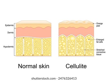 Cellulite formation. Orange peel syndrome.  Adiposis edematosa. Cross section of Cellulite and healthy skin. Skin anatomy. Fat tissue of human body. Vector illustration. Epidermis and dermis texture. 