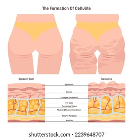 Cellulite and healthy skin structure. Herniation of subcutaneous fat within fibrous connective tissue. Changes in metabolism, physiology and diet. Flat vector illustration.