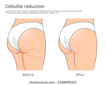 Cellulite And Healthy Skin Vector Illustration. Before And After Reduction Procedure.