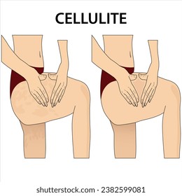 Cellulite illustration health medical issue example