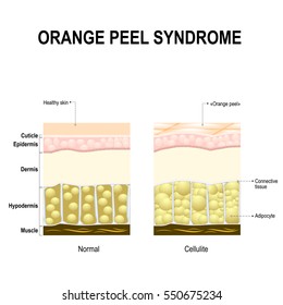 Cellulite also known as orange peel syndrome. healthy skin and skin with cellulite