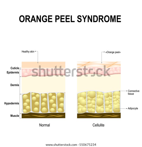オレンジピール症候群とも呼ばれるセルライト セルライトを持つ健康な皮膚と皮膚 のベクター画像素材 ロイヤリティフリー