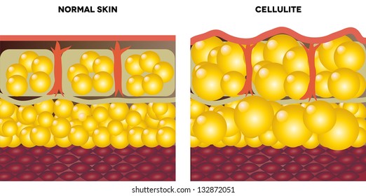 Cellulite and normal skin.