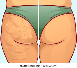 Cellulite on the buttocks, before-after. Vector illustration