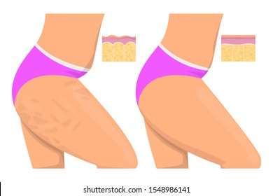 Cellulite on the hips vector isolated. Before and after, female body. Healthy skin and weight loss concept.
