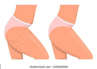 Cellulite on the hips vector isolated. Before and after, female body. Healthy skin and weight loss concept.